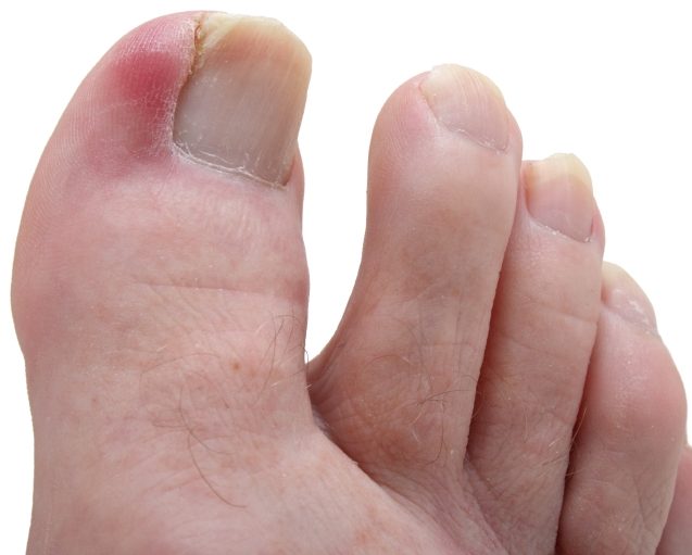 ingrown toenails