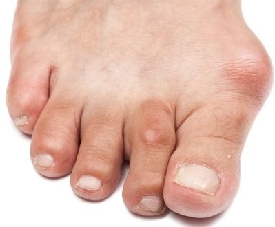 Bunion Surgery Adelaide