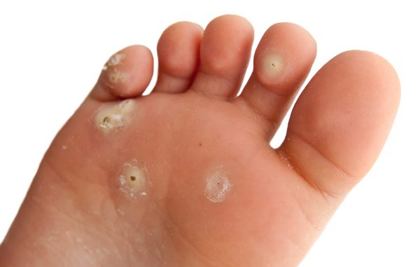 Plantar Warts